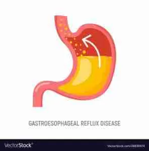 Gastroesophageal Reflux Disease 