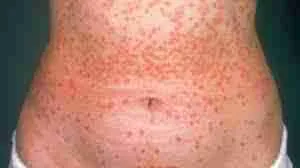 Psoriasis