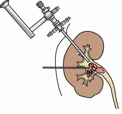 Nephroscopy