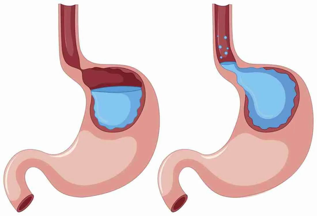 Gastroesophageal Reflux Disease