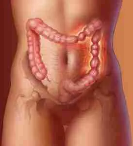 Irritable Bowel Syndrome