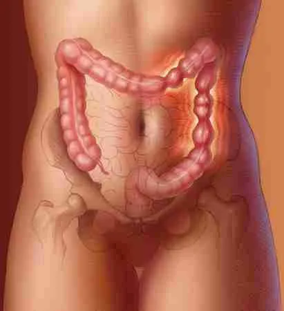 Irritable Bowel Syndrome