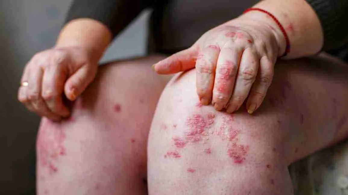 what is Psoriasis?