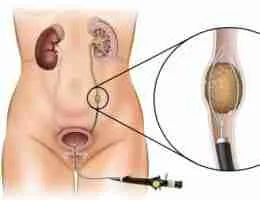 Ureteroscopy-1