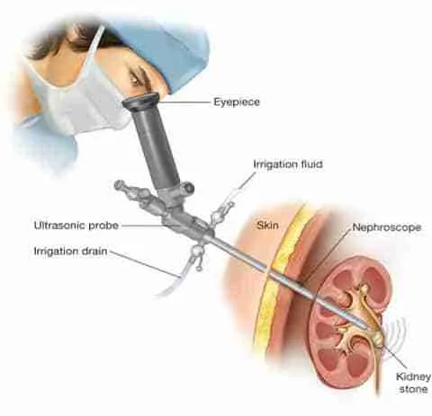 percutaneous-nephrolithotomy-2